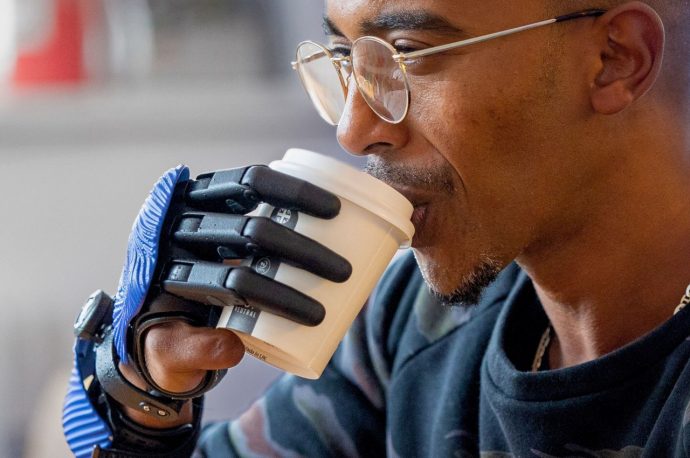 Man with amputated fingers since childhood gets life changing 3D-printed Bionic fingers